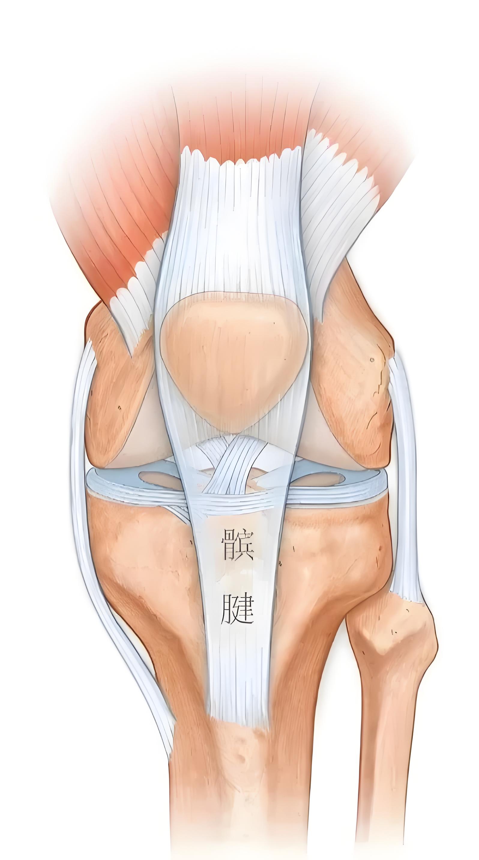 告别髌腱炎困扰，超声波治疗高效修复新选择