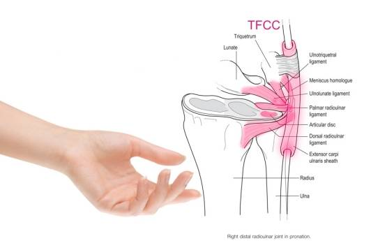 手腕转动不顺，咔咔响？小心TFCC在抗议！